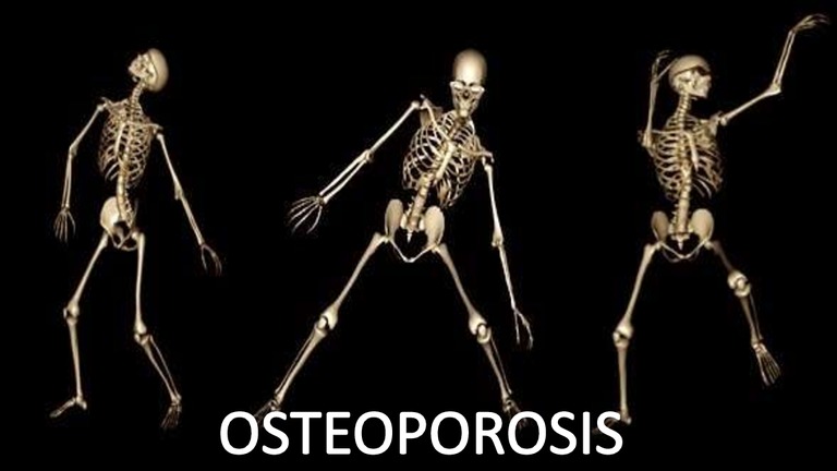 osteoporosis-130910034142-phpapp02-thumbnail-4