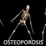 osteoporosis-130910034142-phpapp02-thumbnail-4