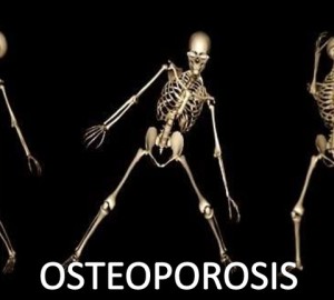 osteoporosis-130910034142-phpapp02-thumbnail-4