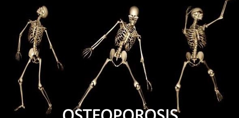 osteoporosis-130910034142-phpapp02-thumbnail-4